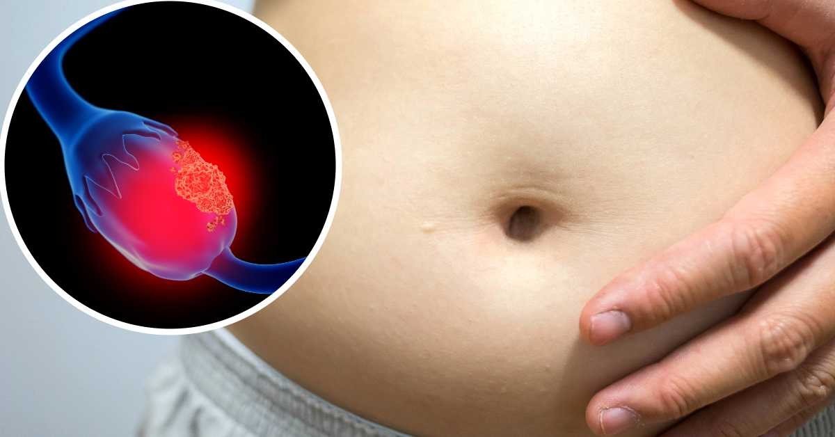 Los primeros síntomas de cáncer de ovario: causas, consejos y prevención