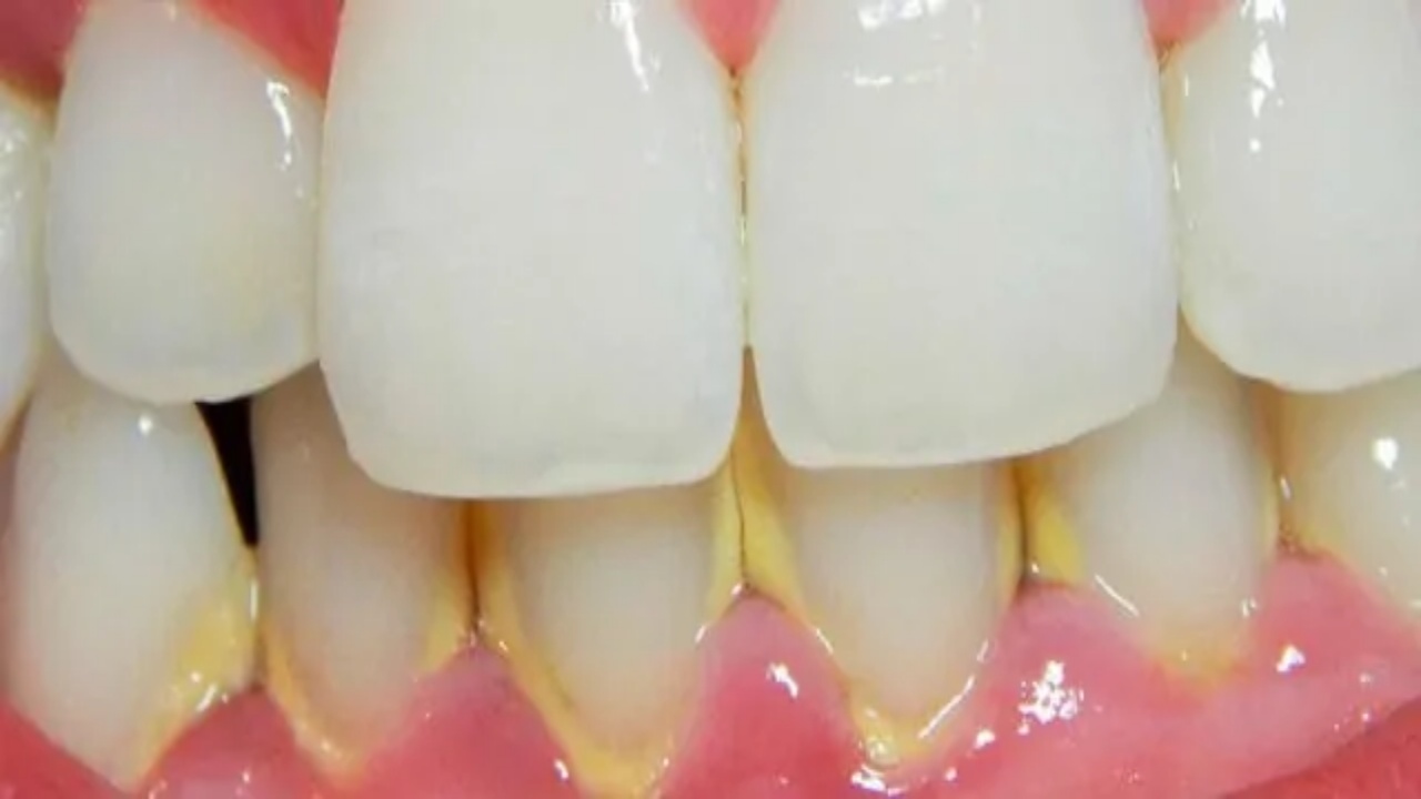 Remedios Caseros para Eliminar el Sarro Dental
