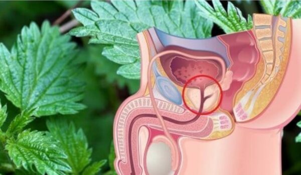 Ortiga para Mejorar la Próstata: Receta Detallada, Consejos y Síntomas