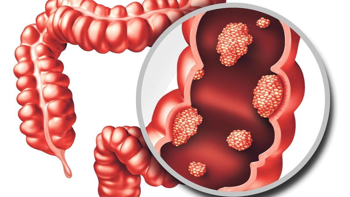 Cáncer