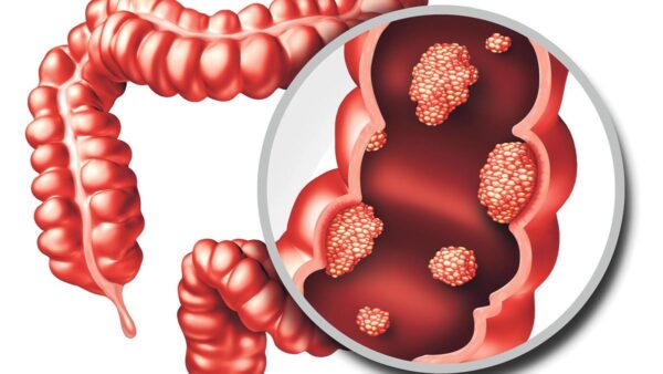 Cáncer de Colon: Síntomas, Signos de Advertencia y Consejos para la Detección Temprana