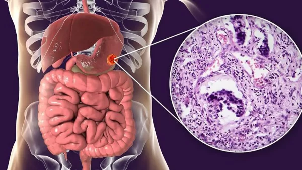 Cáncer de Estómago: Síntomas, Signos de Advertencia y Consejos para la Detección Temprana