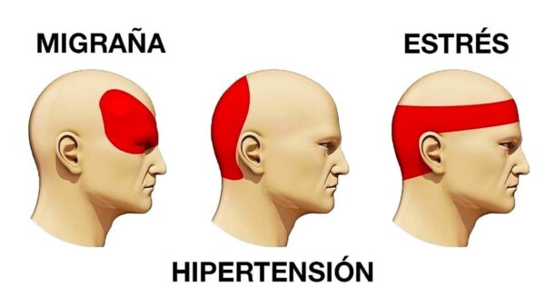 Alivio Natural: Técnicas Caseras para el Dolor de Cabeza, Migraña y Estrés