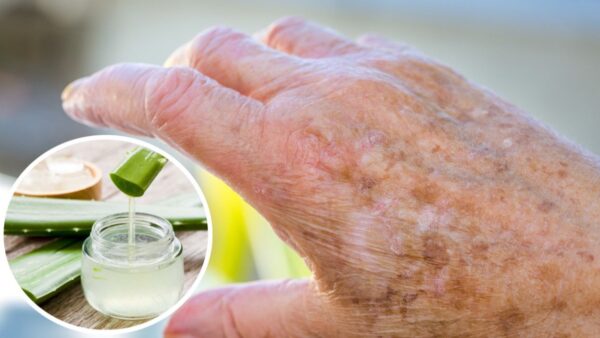 Remedios Caseros para Eliminar Manchas de las Manos