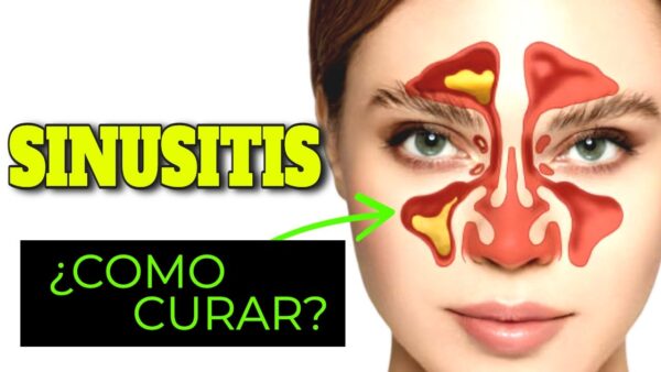 Remedios para la Sinusitis, Congestión y Gripe