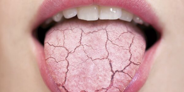 Adiós a la Boca Seca al Despertar: Tratamientos Naturales y Consejos Efectivos