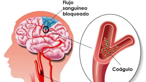 "Señales de Advertencia de un Derrame Cerebral: Síntomas, Consejos y Cuándo Buscar Ayuda Médica"