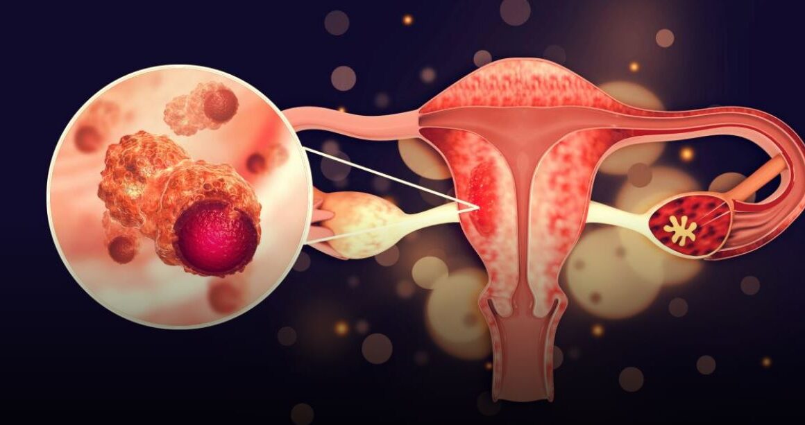 cáncer de ovario