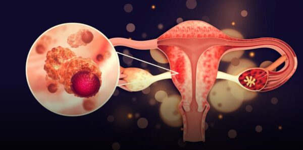 "Si eres mujer, debes leer esto: Descubre los primeros síntomas del cáncer de ovario y cómo tratarlo"