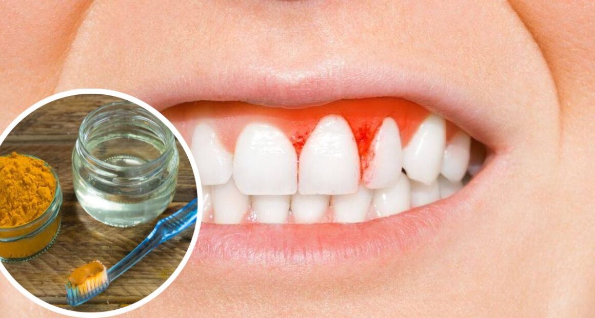 Gingivitis