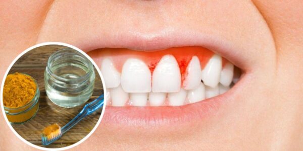 Trata la Gingivitis con Estos Remedios Caseros Eficaces y Blanquea los Dientes de Forma Natural