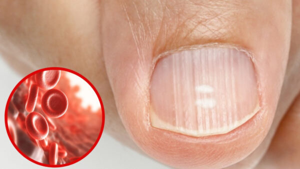 Líneas en las Uñas: ¿Qué Son y Qué Indican Sobre Tu Salud?