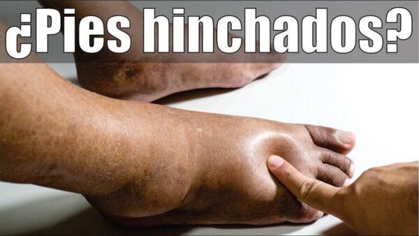 "Remedios Efectivos y Consejos para Reducir la Hinchazón en los Pies y Mejorar la Circulación"