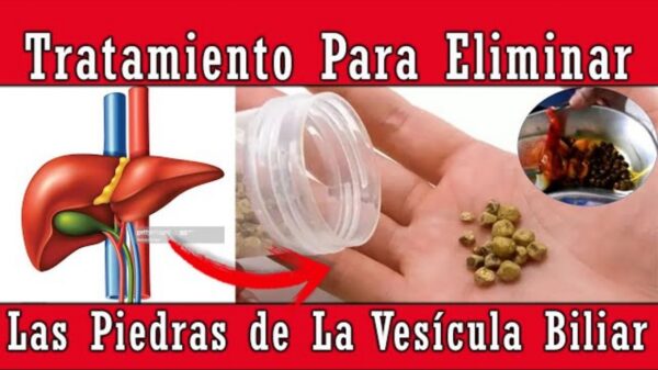 "¿Cálculos en la Vesícula? Descubre el Mejor Tratamiento Casero para Disolverlos"