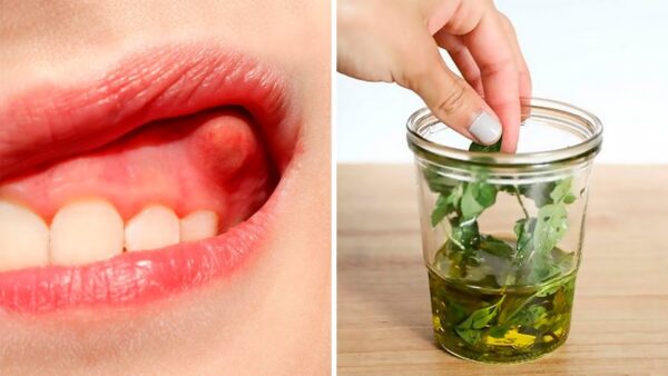 "Descubra cómo el aceite de orégano puede curar su absceso dental naturalmente"