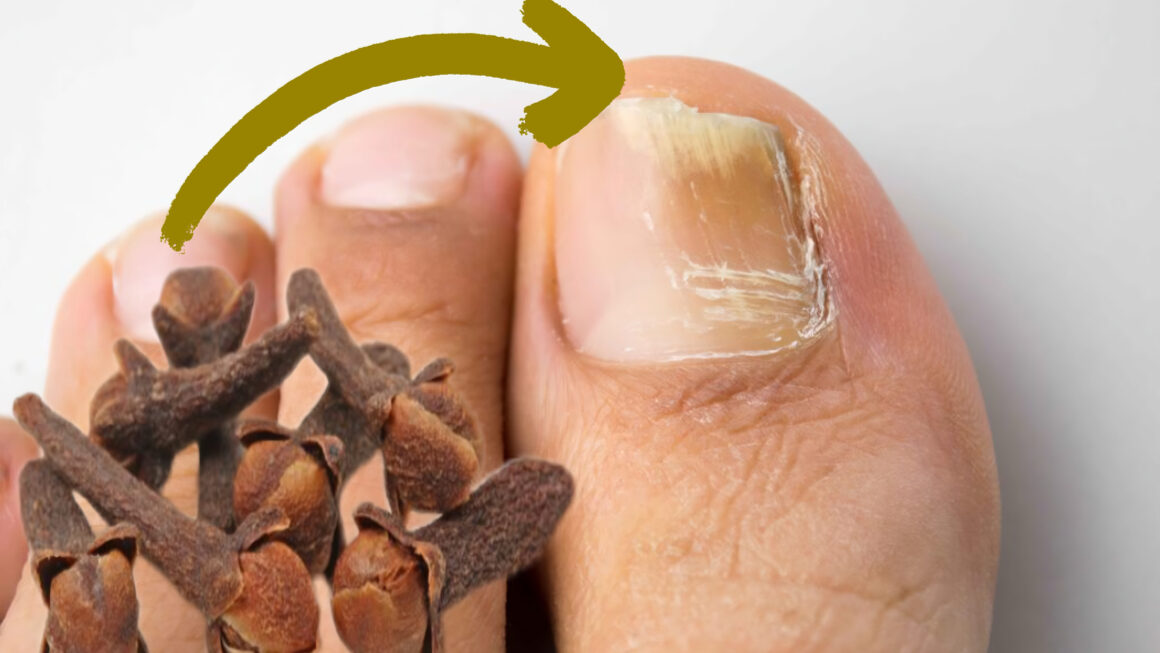 hongos en las uñas