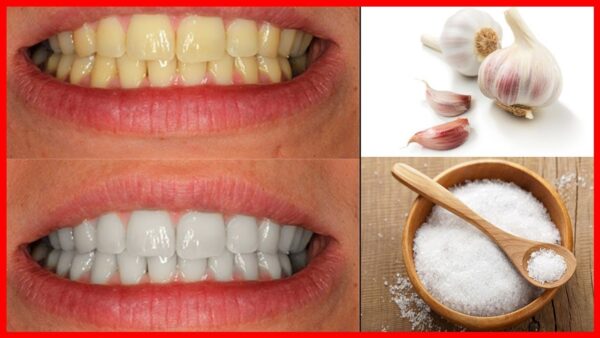 ¿Sabías que el ajo puede blanquear tus dientes? Descubre cómo usarlo eficazmente