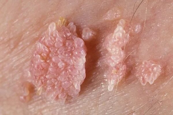 "VPH: Prevención, riesgos y remedios naturales para combatirlo"