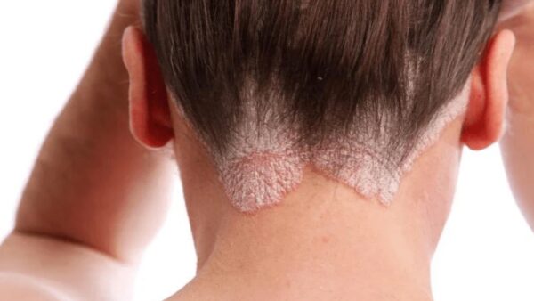 "Dermatitis Seborreica: Síntomas, Causas y Remedios Naturales"