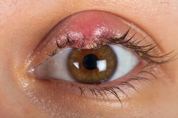 "Orzuelos en el Ojo: Tratamientos Naturales que Funcionan"