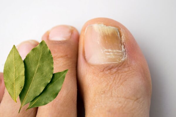 Cómo eliminar hongos de las uñas con laurel