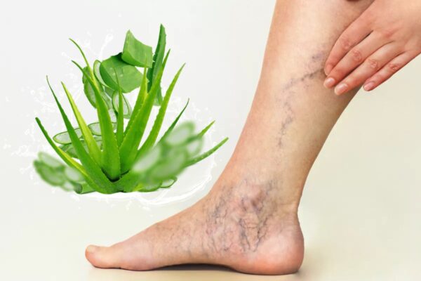 "Aloe Vera para Piernas Pesadas y Várices: Remedio Natural Efectivo"