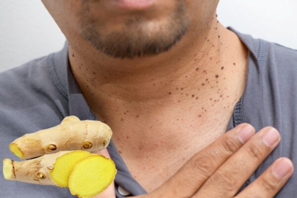 Elimina Verrugas con Jengibre: Un Remedio Natural Eficaz